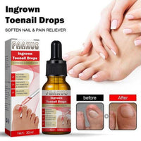 Ingrown Toenail Drops 60 ml Pack of 2