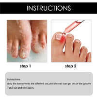 Ingrown Toenail Drops 60 ml Pack of 2